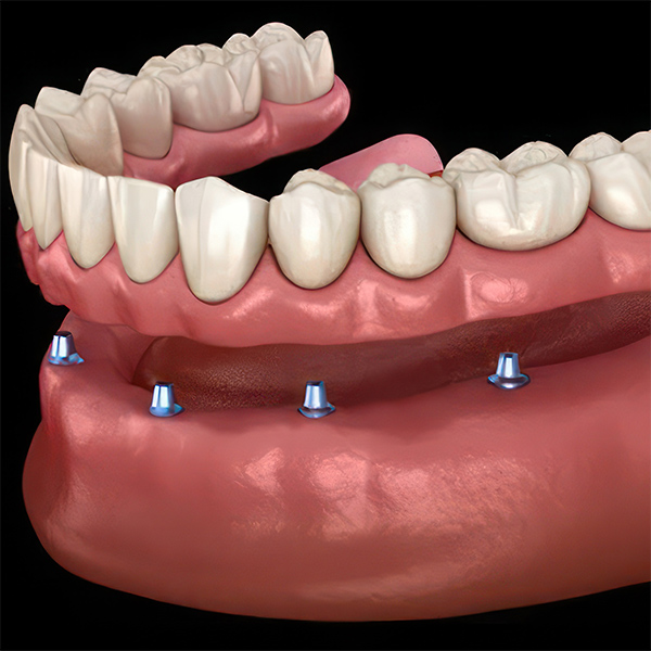 Implant denture