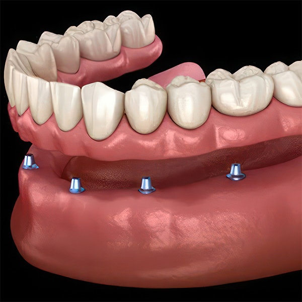 Implant denture