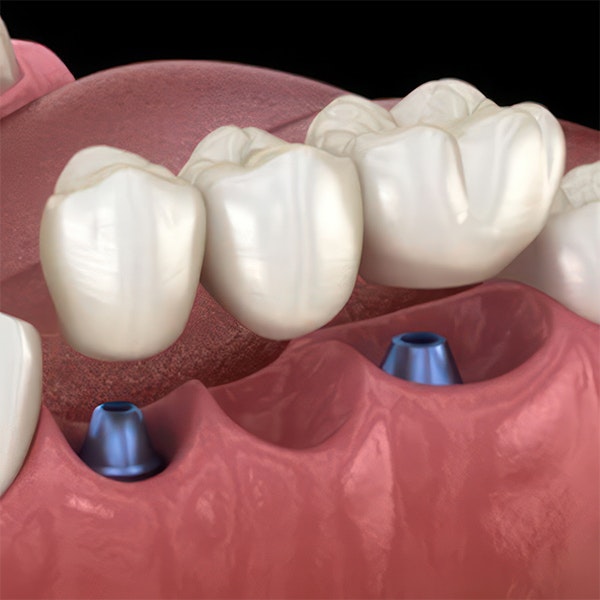Implant bridge
