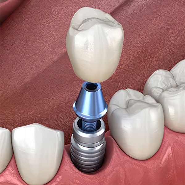 Implant crown