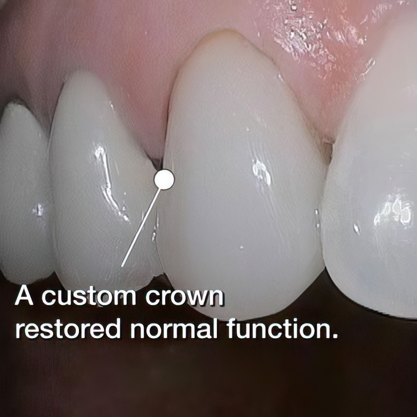 After dental crown placement