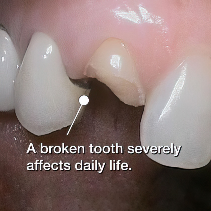 Chipped tooth before crown placement