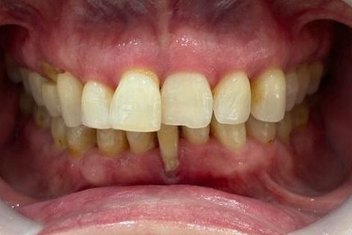 Dr. Steven Krendl's Patient Before Dental Implants