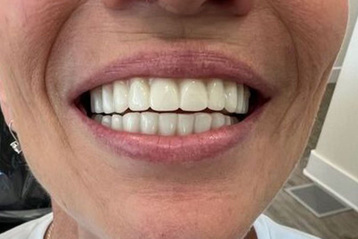 Dr. Steven Krendl's Patient After Dental Implants