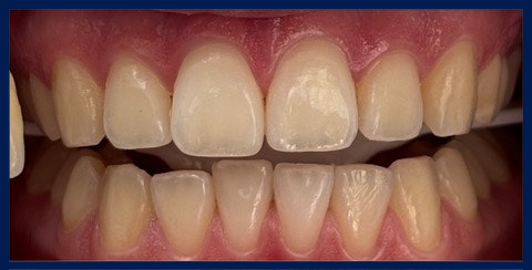 Littleton patient before teeth whitening