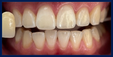 Littleton patient after teeth whitening