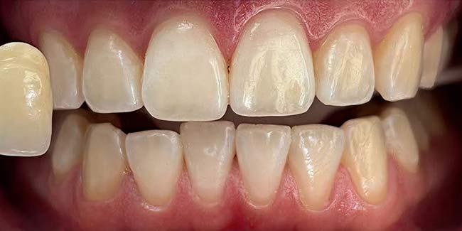Littleton patient after teeth whitening