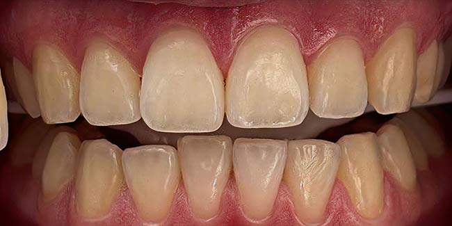 Littleton patient before teeth whitening
