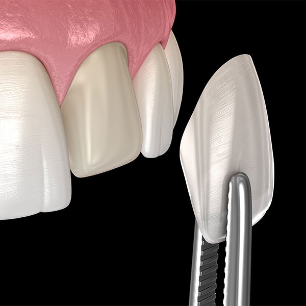 3D illustration of veneer