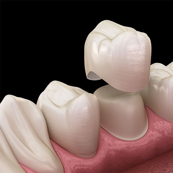 Dental crown