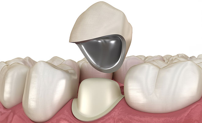 Porcelain-Fused-to-Metal Crown
