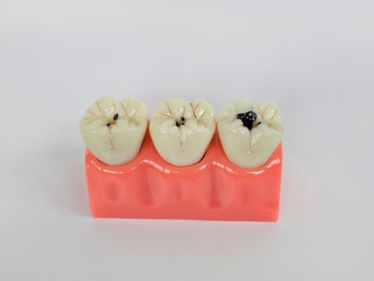 Dentist pointing at a model of a decaying tooth