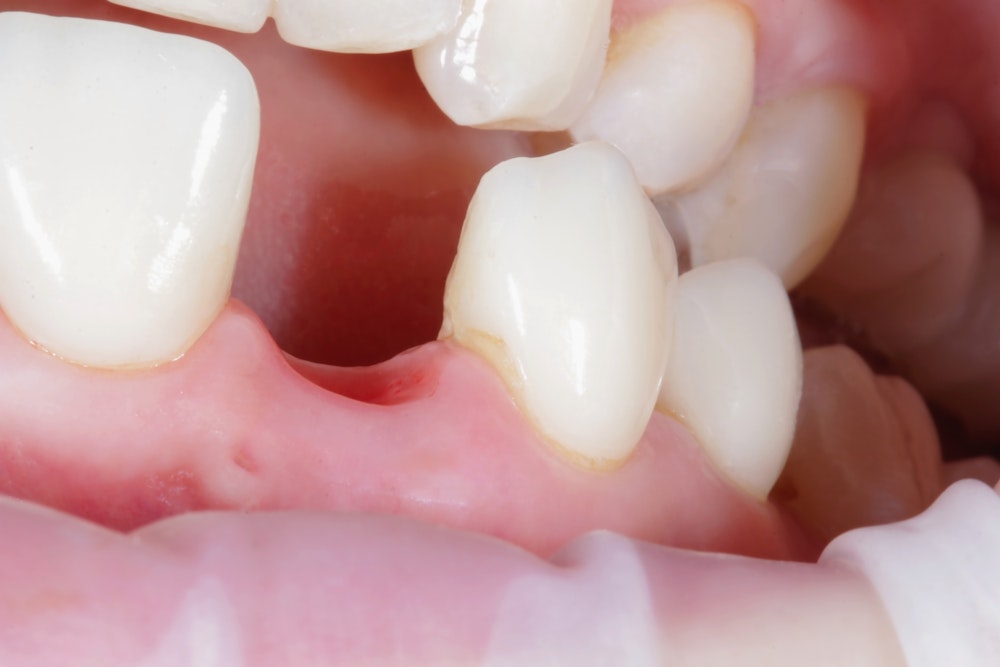 Close-up of a missing tooth with surrounding gum tissue and adjacent natural teeth