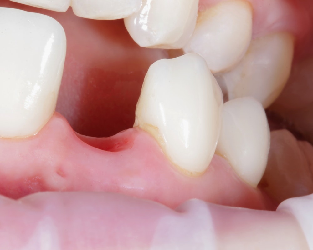 Close-up of a missing tooth with surrounding gum tissue and adjacent natural teeth