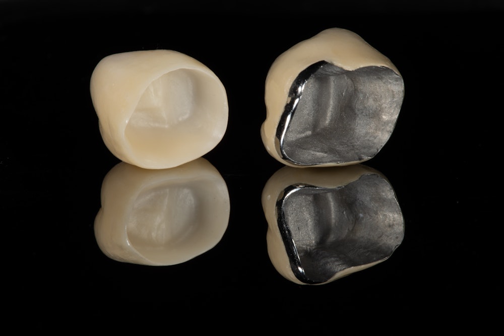 Porcelain-fused-to-metal dental crowns displayed on a black background showing the metal interior and porcelain exterior