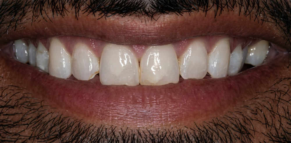 Patient's smile before veneers
