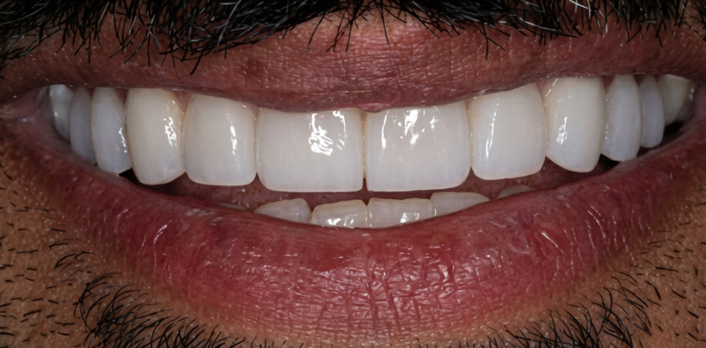Patient's smile after veneers