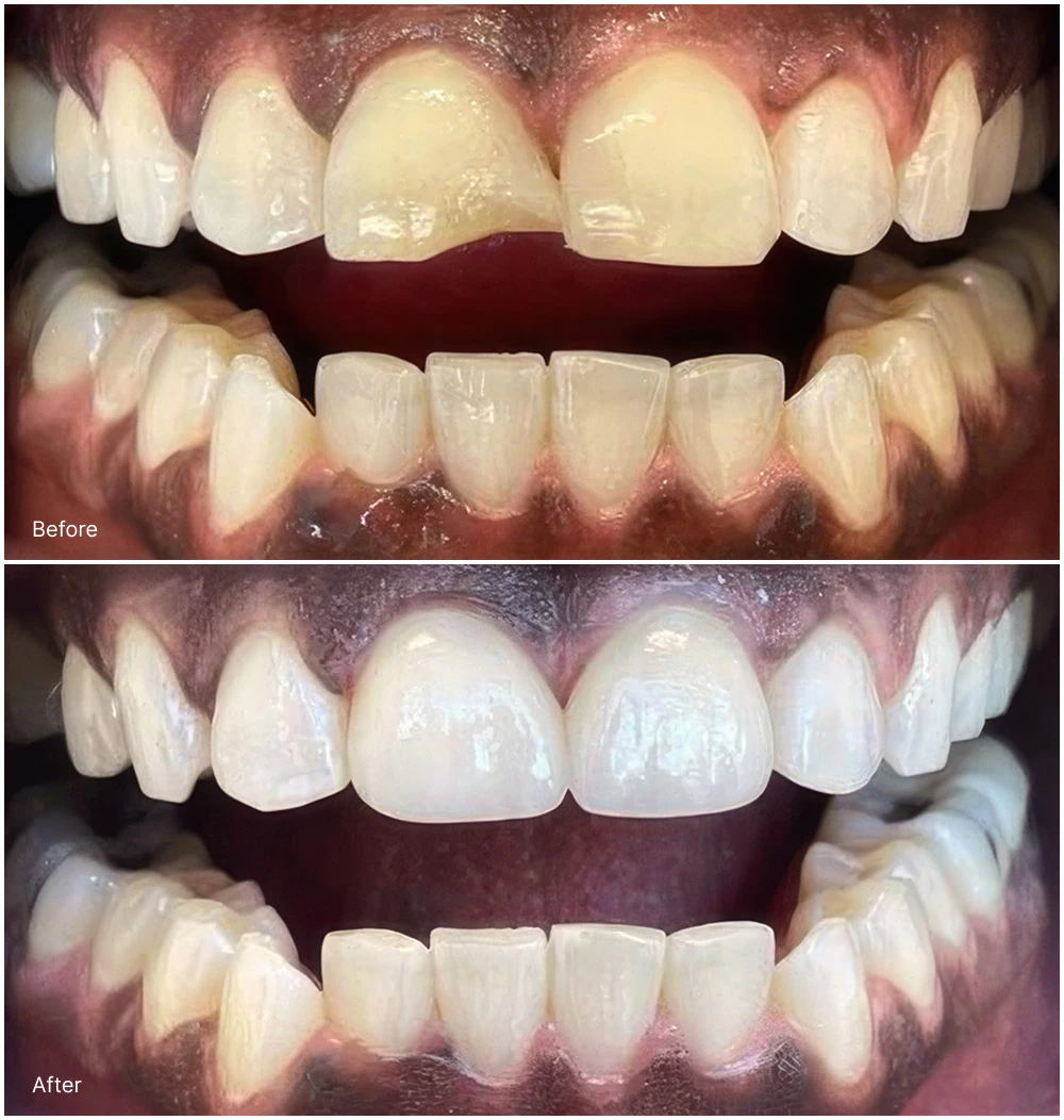 Veneer results before and after