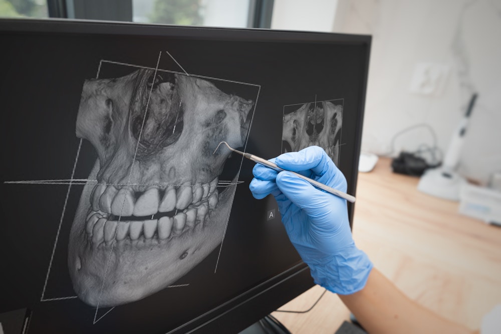 X-ray of teeth