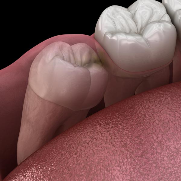 wisdom tooth under the gums