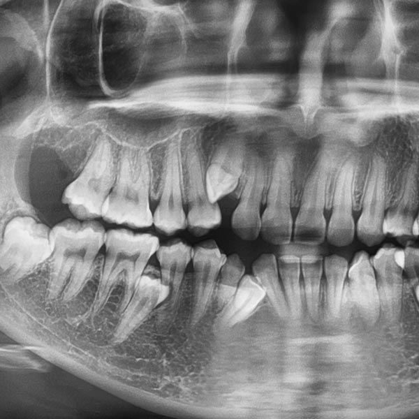 tooth impaction x-ray