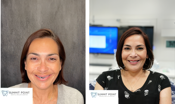 a patient before and after dental implant treatment