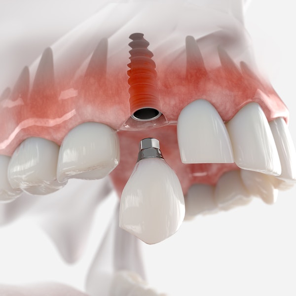 Implant crown