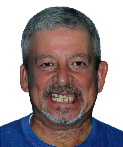 Dr. Khodabakhsh's patient before full mouth reconstruction