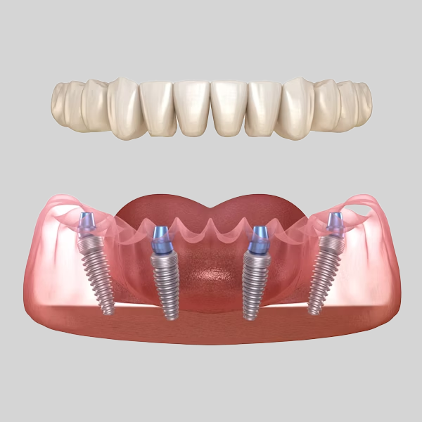 All-on-4 Dental Implants illustration