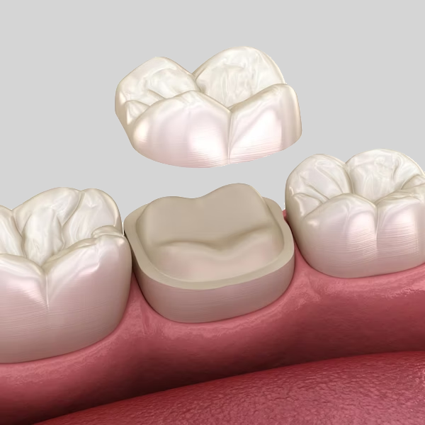 Dental Crown over original tooth
