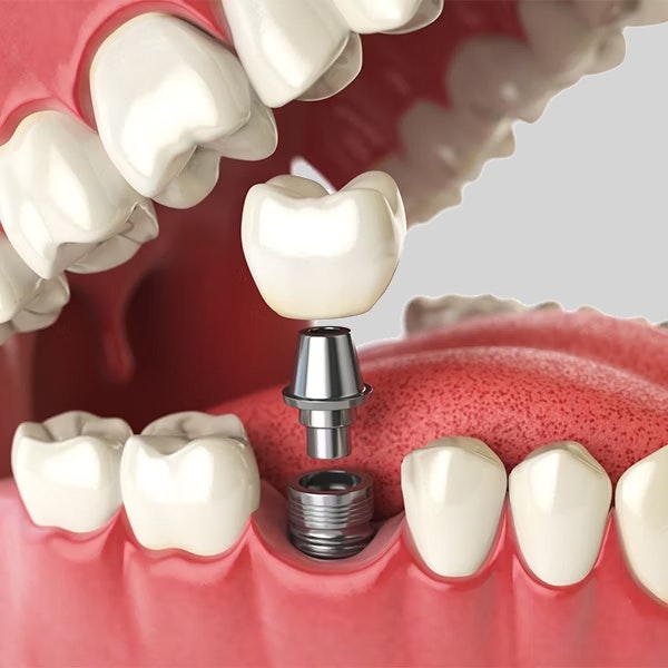 dental implants