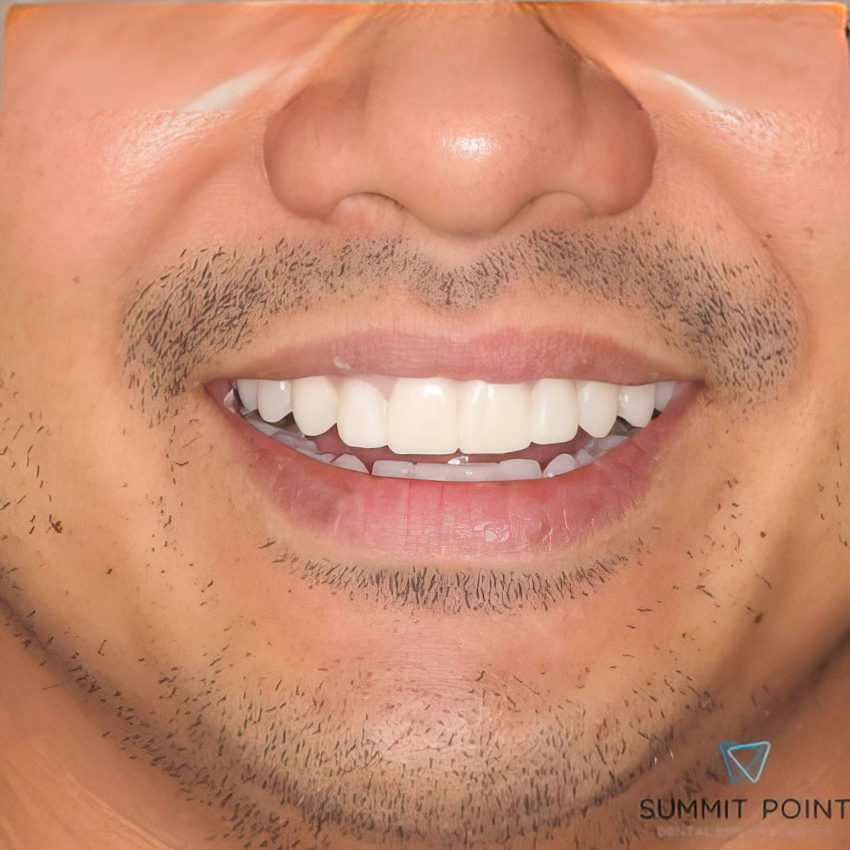 veneer patient