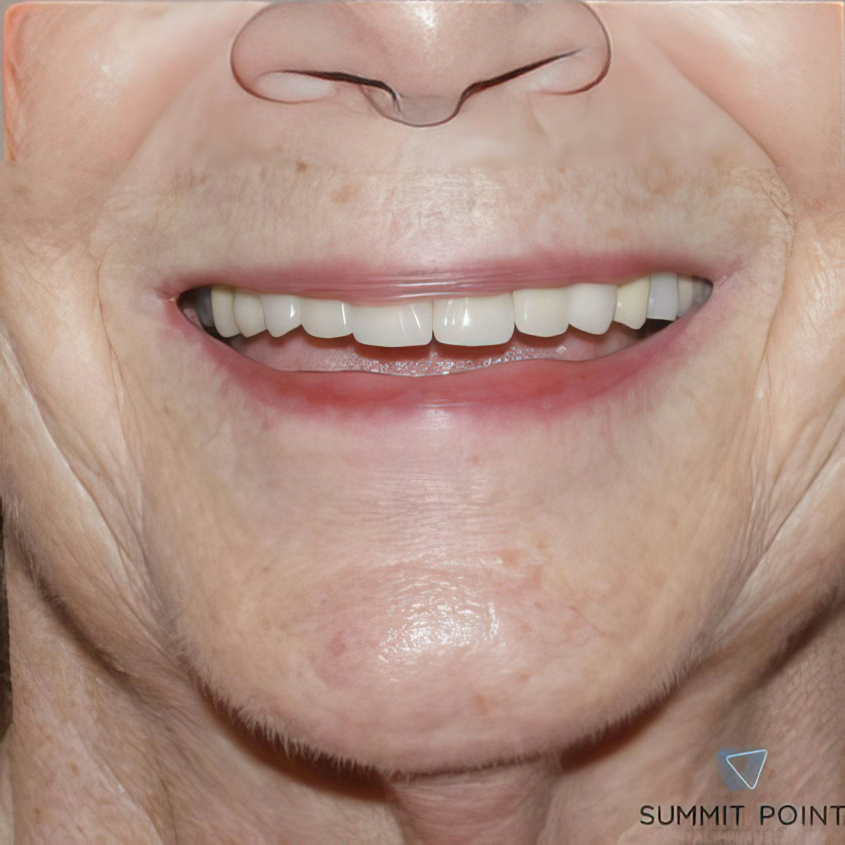 dental crowns patient