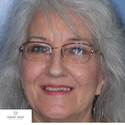 Dr. Khodabakhsh's patient before full mouth reconstruction