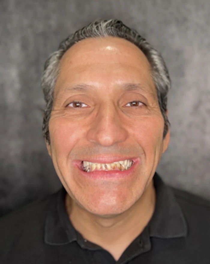 Yovany before treatment, wearing removable dentures
