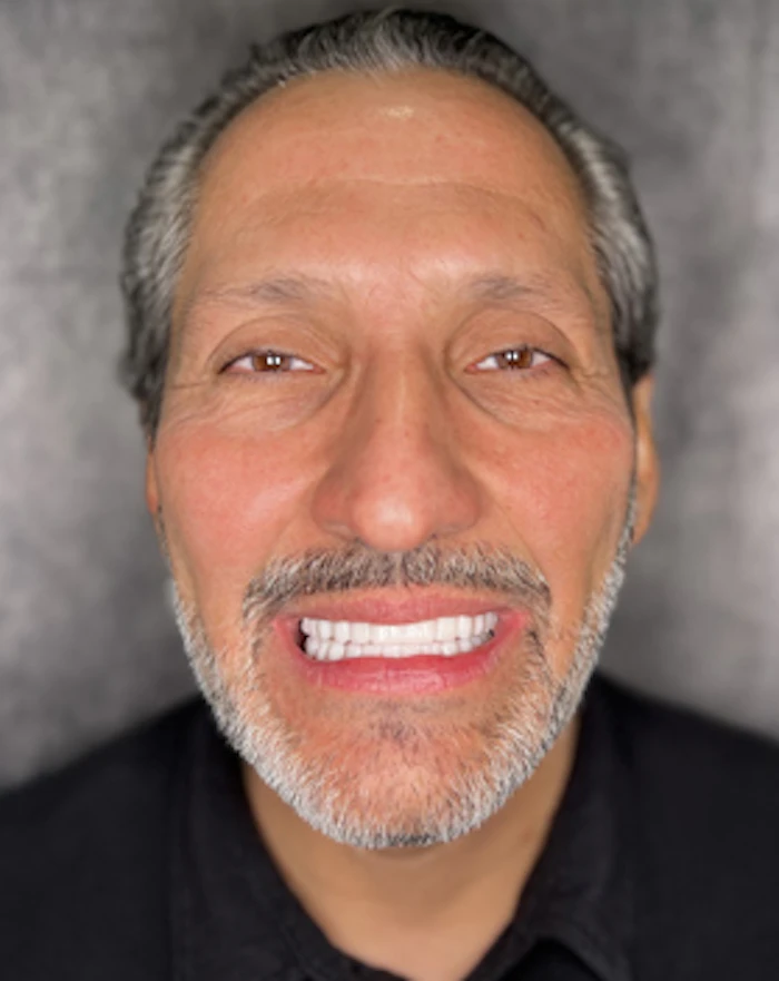 Yovany after treatment, with a fixed implant-supported denture
