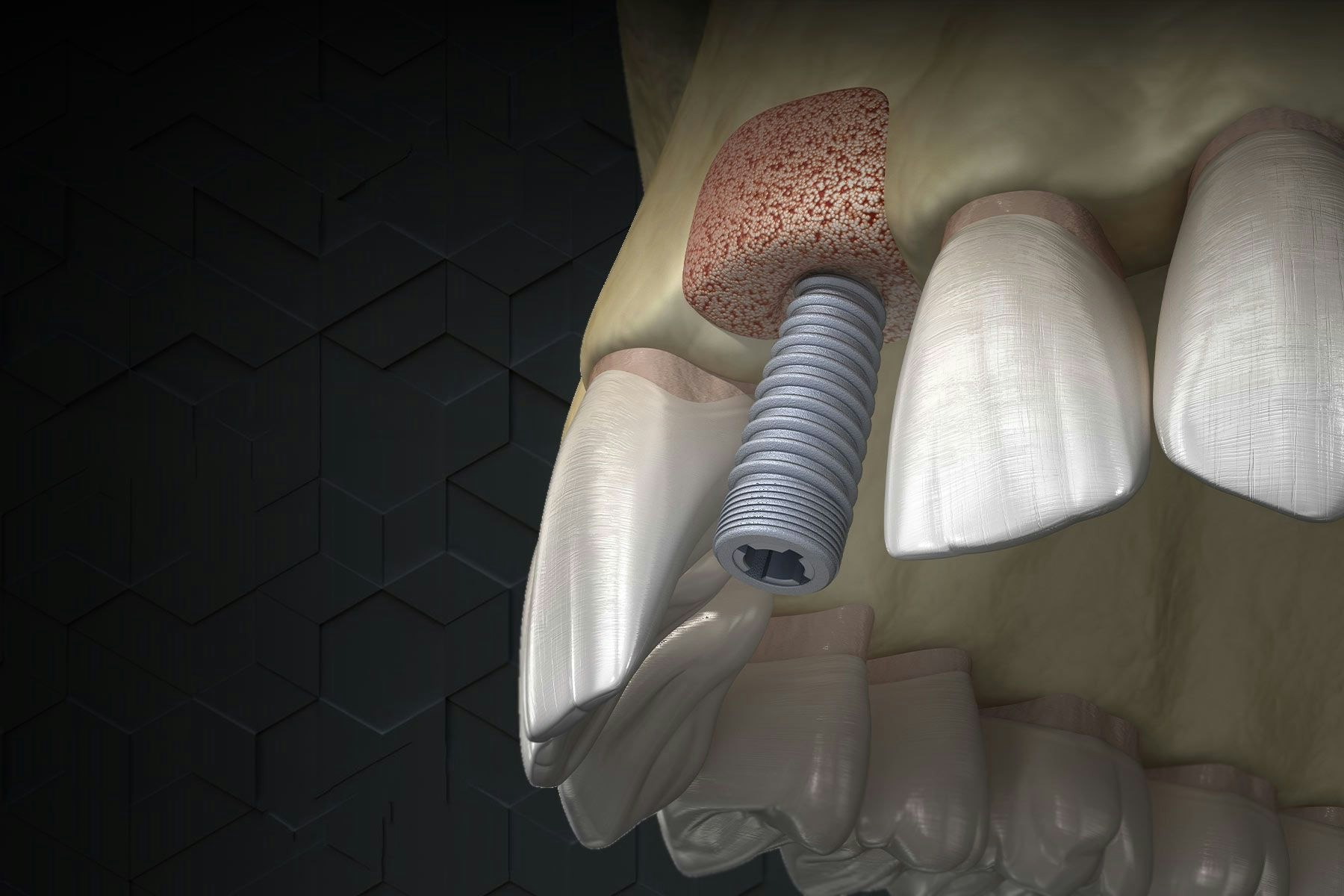 dental implant
