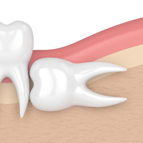 Horizontal impaction