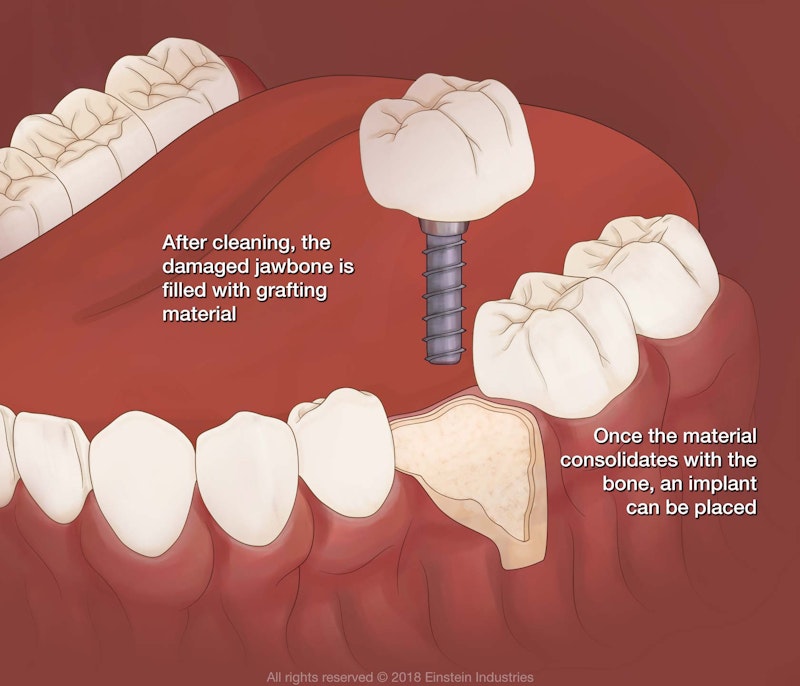 An illustration of how a bone graft can improve the success of dental implant treatment