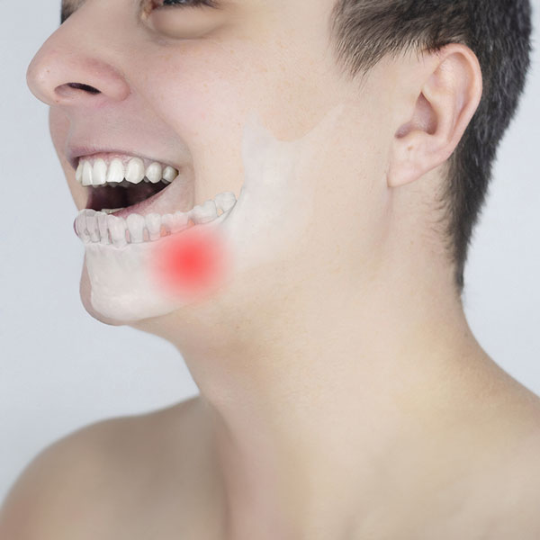 Profile view of a young man with an x-ray view of his misaligned jaw
