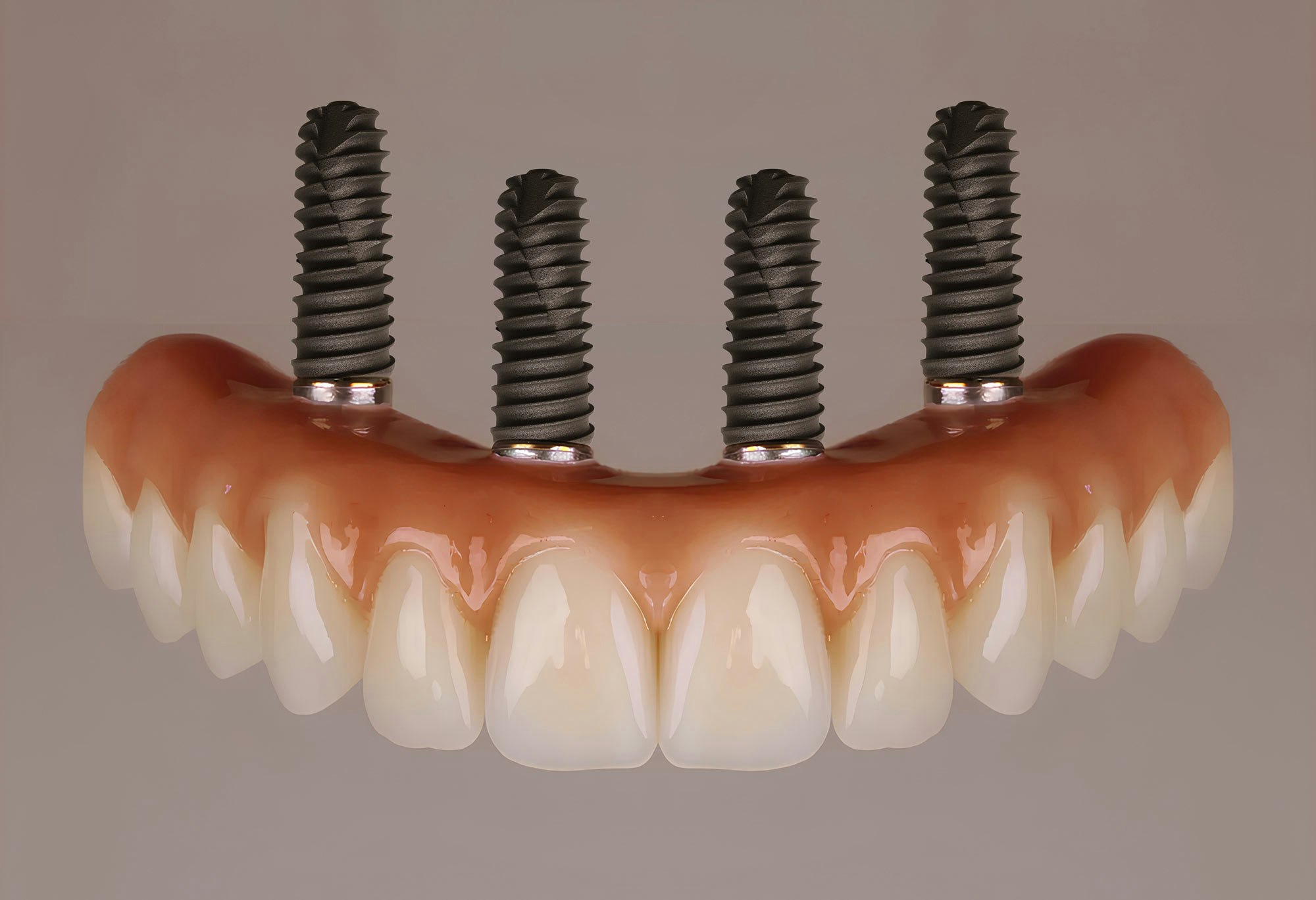 implant-supported denture