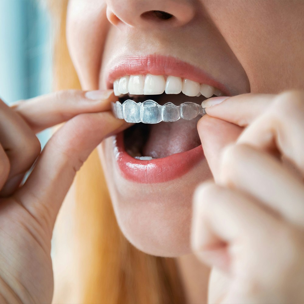 Lady putting on ClearCorrect