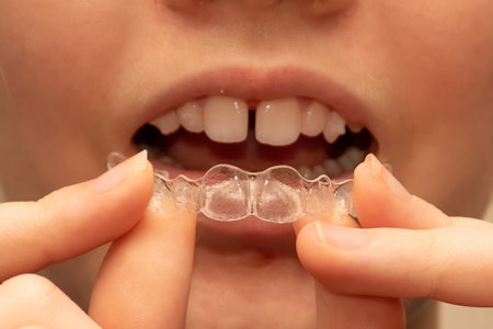 person with gapped front teeth placing clear aligners