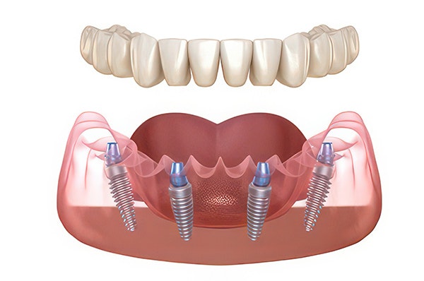 All-on-4 denture diagram