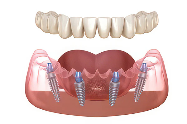 illustration of implant denture