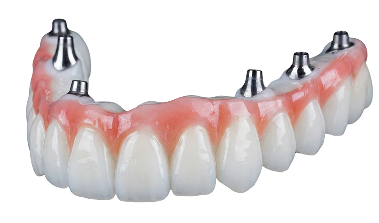 implant denture