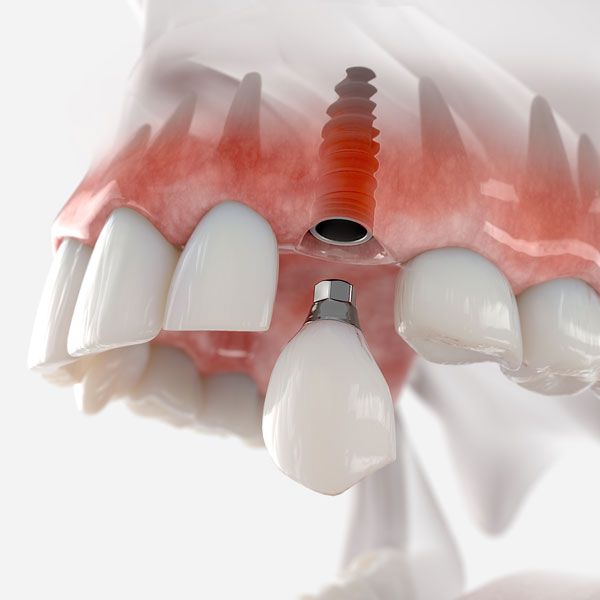 Dental implant