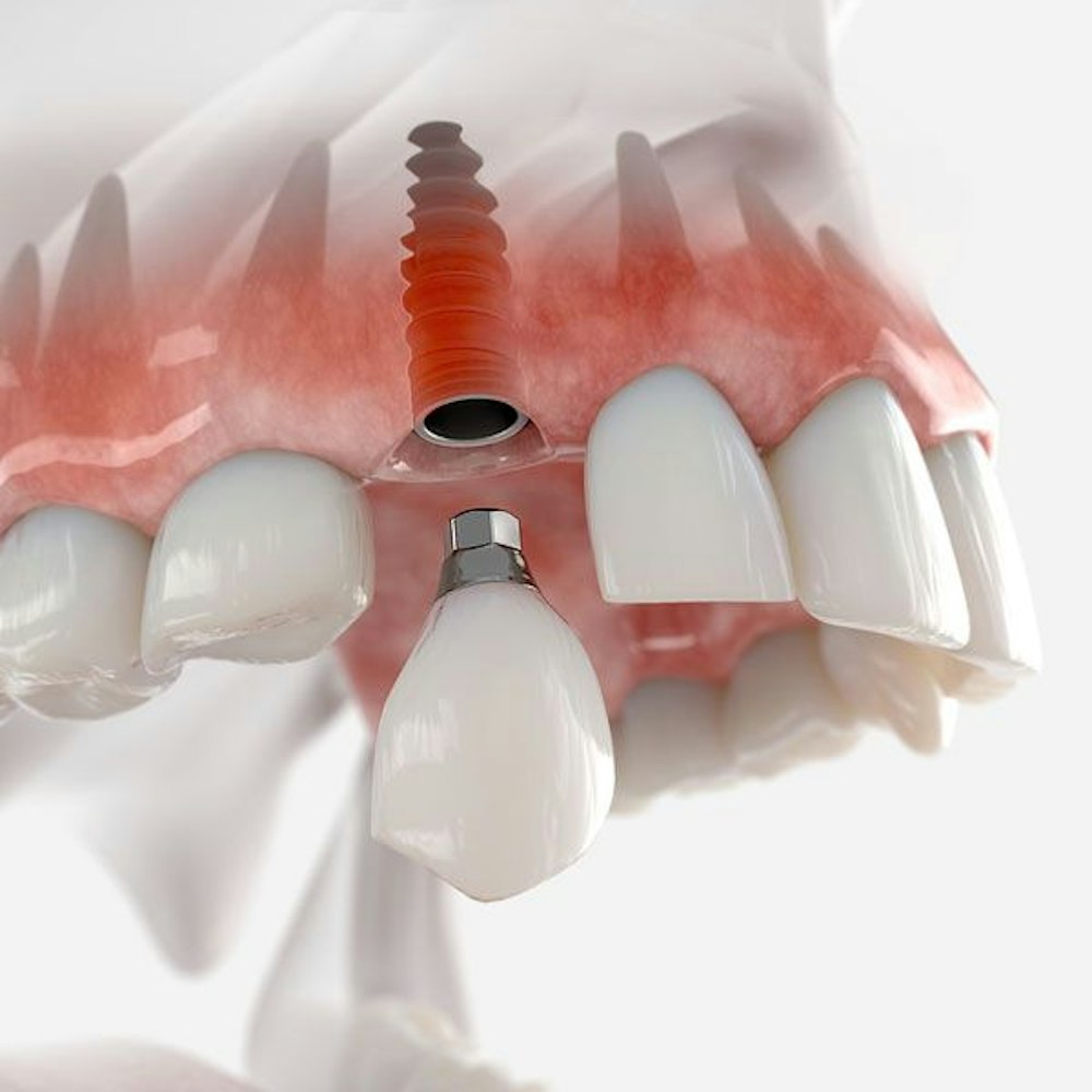 Dental implant