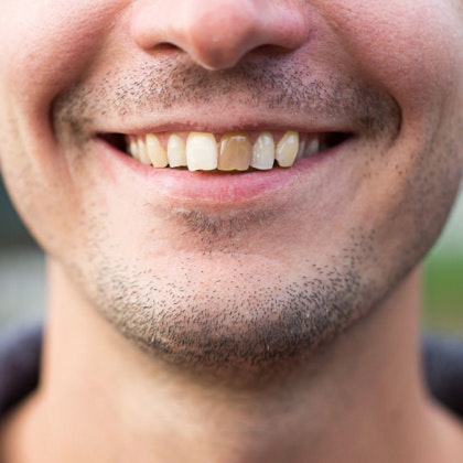 Man with discolored tooth