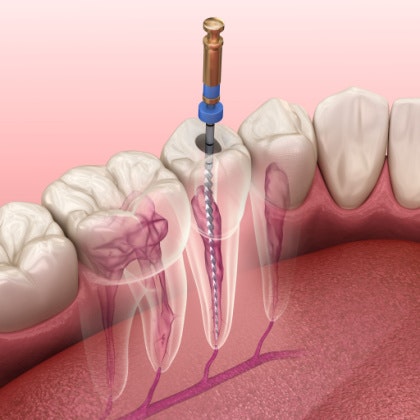 Illustration of a root canal being done